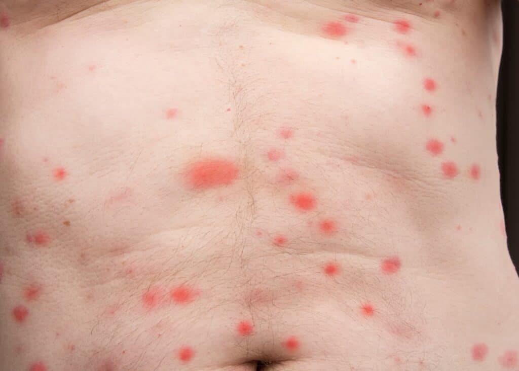 photo de piqûres de punaises de lit sur la peau humaine